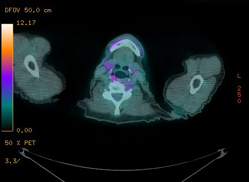 Appendiceal adenocarcinoma complicated by retroperitoneal abscess (Radiopaedia 58007-65041 Axial PET-CT 17).jpg