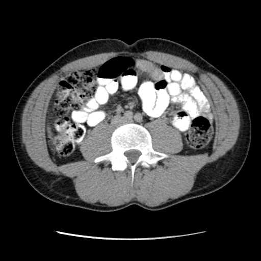Appendicitis complicated by post-operative collection (Radiopaedia 35595-37113 A 41).jpg