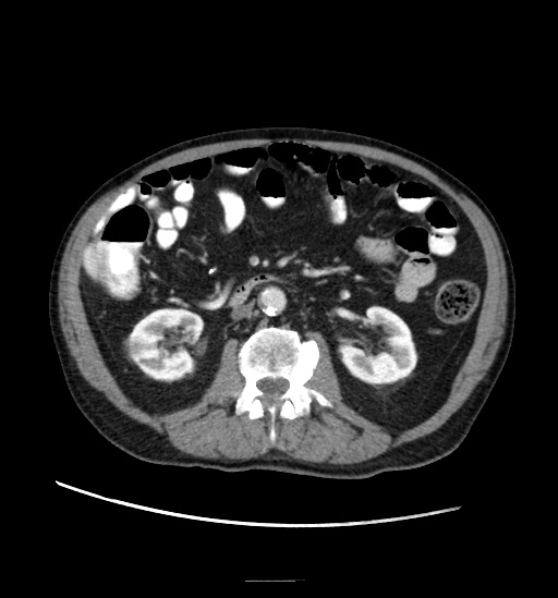 Appendicitis with localized perforation and abscess formation (Radiopaedia 49035-54130 A 43).jpg