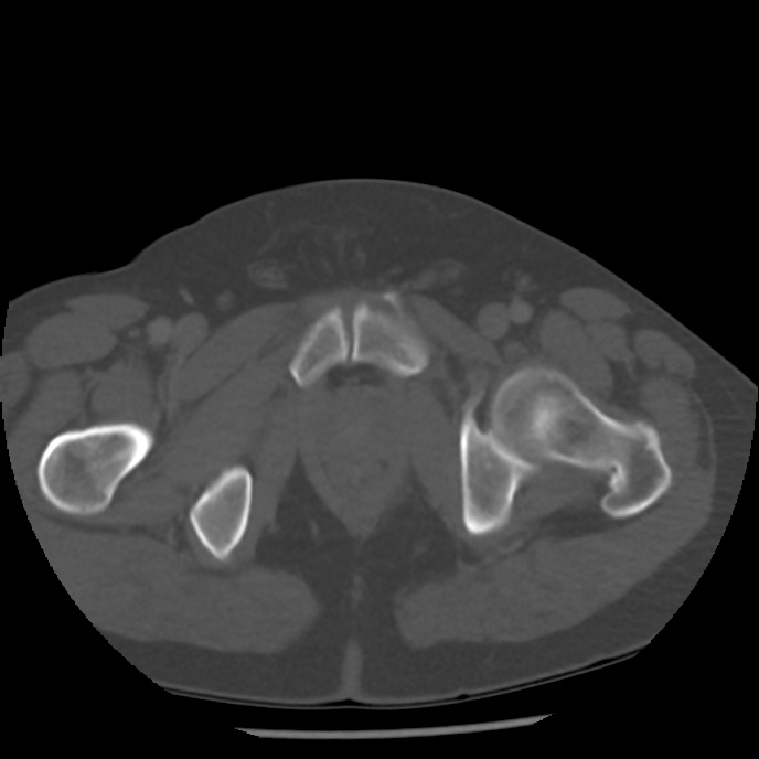 Appendicitis with perforation (Radiopaedia 35790-37342 Axial bone window 54).jpg