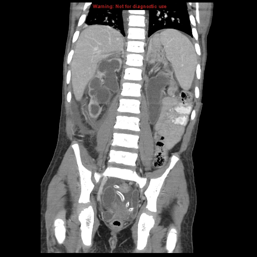 File:Appendicitis with phlegmon (Radiopaedia 9358-10046 B 47).jpg