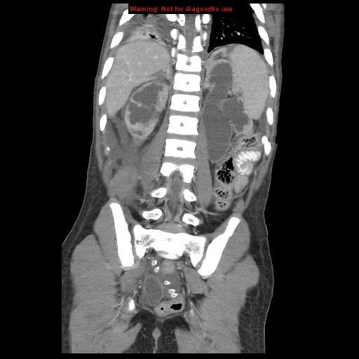 File:Appendicitis with phlegmon (Radiopaedia 9358-10046 B 52).jpg