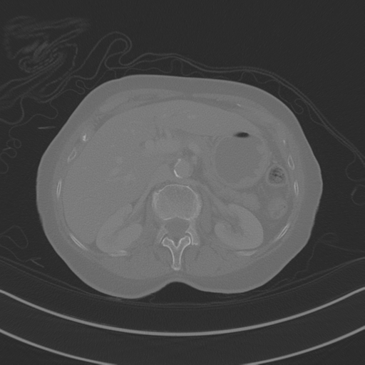 April fools' 2019- calcified peritoneal arachnoidosis (Radiopaedia 67273-76636 Axial bone window 8).png