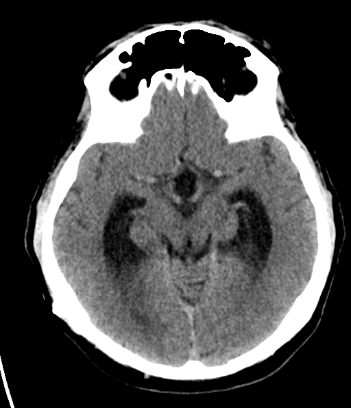 File:Aqueduct stenosis with corpus callosum hypoattenuation post shunting (Radiopaedia 37212-38973 Axial non-contrast 13).png