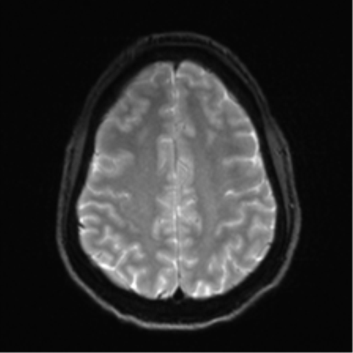Arachnoid cyst - cerebellopontine angle (Radiopaedia 59689-67083 Axial DWI 27).png