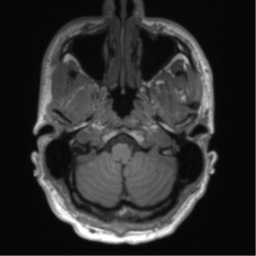 File:Arachnoid cyst with subdural hematoma (Radiopaedia 85892-101743 Axial T1 16).png