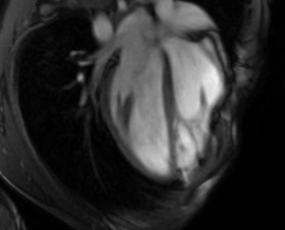 Arrhythmogenic right ventricular cardiomyopathy (Radiopaedia 69564-79464 4ch cine 56).jpg