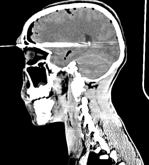 Arrow injury to the brain (Radiopaedia 72101-82607 H 41).jpg