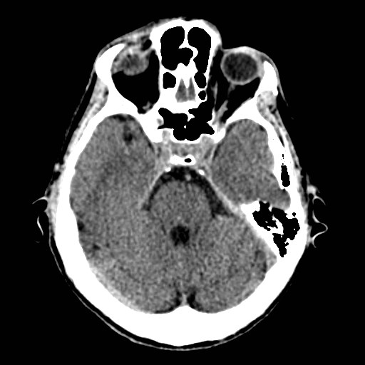 File:Artery of Percheron infarct (Radiopaedia 48088-52893 Axial non-contrast 12).jpg