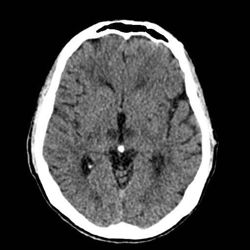 File:Artery of Percheron infarct (Radiopaedia 48088-52893 Axial non-contrast 20).jpg