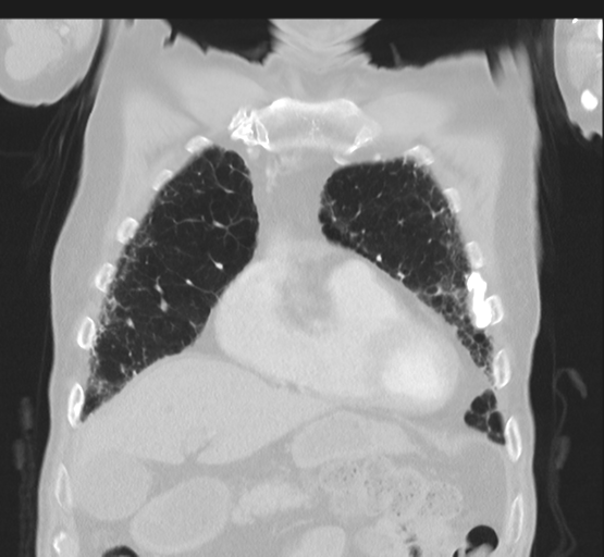 File:Asbestosis (Radiopaedia 56192-62864 Coronal lung window 14).png