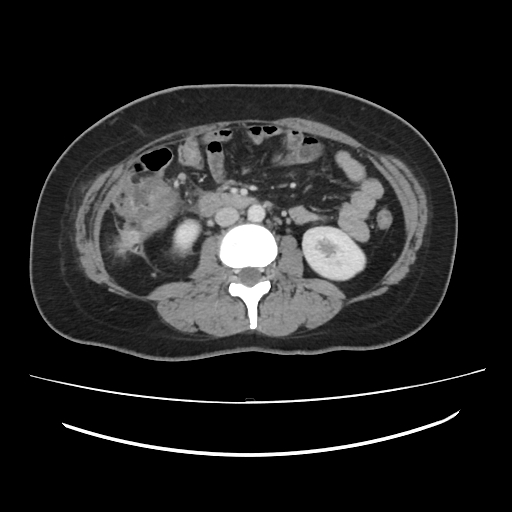 File:Ascending retrocecal appendicitis with liver abscesses (Radiopaedia 60066-67615 B 47).jpg