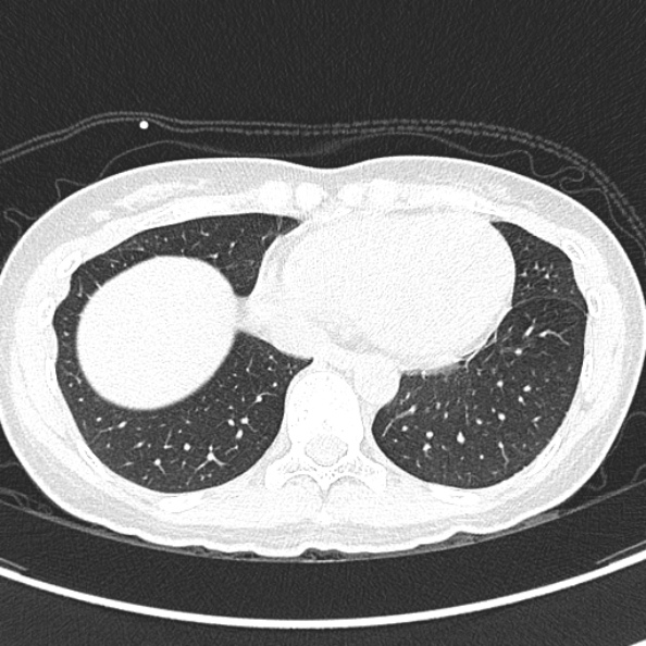 Aspergilloma (Radiopaedia 26223-26347 Axial lung window 58).jpg