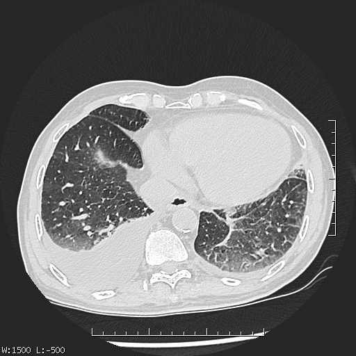 Aspergilloma (Radiopaedia 75184-86270 Axial lung window 42).jpg