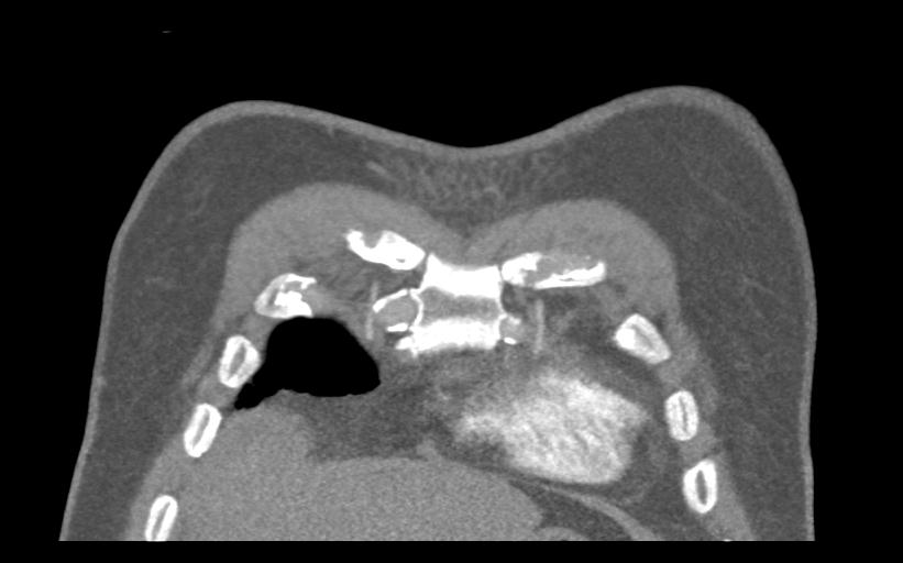 Aspirated tooth (Radiopaedia 28584-28844 Coronal C+ CTPA 10).jpg