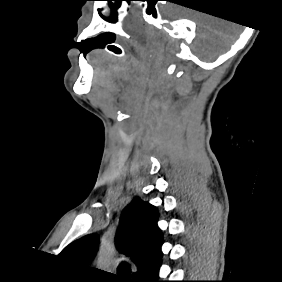 Atlanto-occipital dissociation (Traynelis type 1), C2 teardrop fracture, C6-7 facet joint dislocation (Radiopaedia 87655-104061 D 32).jpg