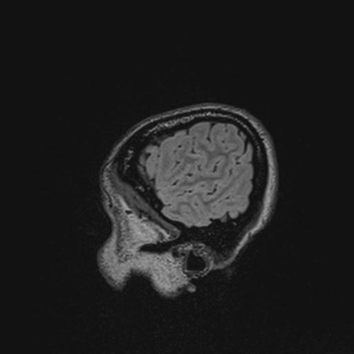 Atretic encephalocoele with inferior vermis hypoplasia (Radiopaedia 30443-31108 Sagittal FLAIR 27).jpg