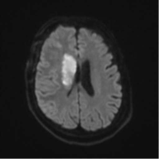 File:Atypical meningioma (WHO Grade II) (Radiopaedia 54742-60981 Axial DWI 46).png