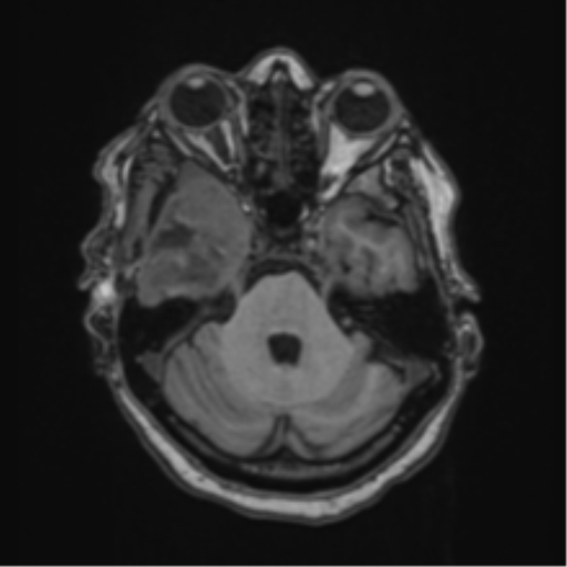 Atypical meningioma (WHO Grade II) (Radiopaedia 54742-60981 Axial T1 19).png