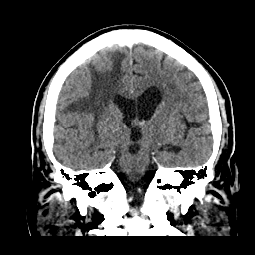 Atypical meningioma (WHO grade II) with brain invasion (Radiopaedia 57767-64728 Coronal C+ 33).png