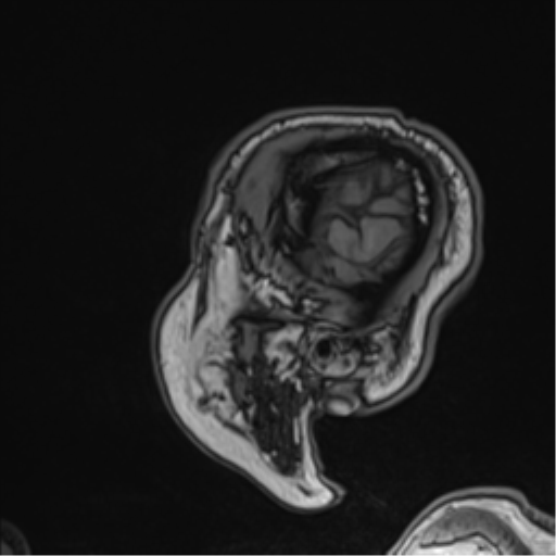 Atypical meningioma (WHO grade II) with brain invasion (Radiopaedia 57767-64729 Sagittal T1 59).png
