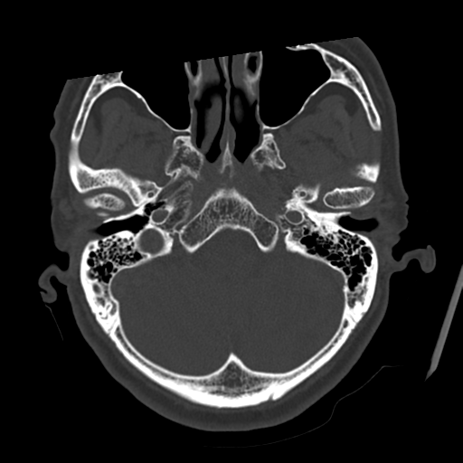 Atypical meningioma (WHO grade II) with osseous invasion (Radiopaedia 53654-59715 Axial bone window 17).png