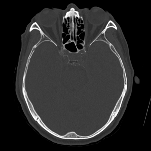 Atypical meningioma (WHO grade II) with osseous invasion (Radiopaedia 53654-59715 Axial bone window 30).png