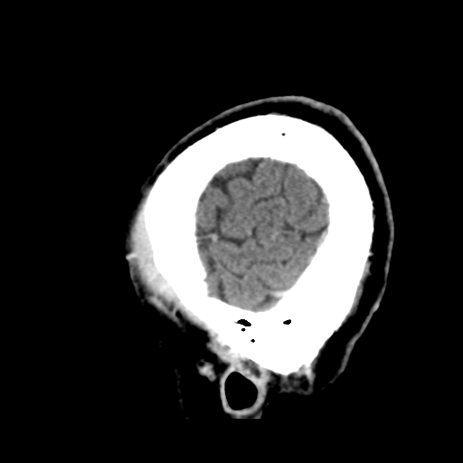 File:Atypical meningioma (WHO grade II) with osseous invasion (Radiopaedia 53654-59715 G 49).png