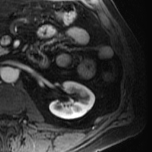 File:Atypical renal cyst on MRI (Radiopaedia 17349-17046 C 18).jpg