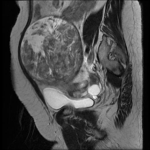 File:Atypical retroperitoneal lymphocoeles with large leiomyoma of uterus (Radiopaedia 32084-33027 Sagittal T2 23).jpg