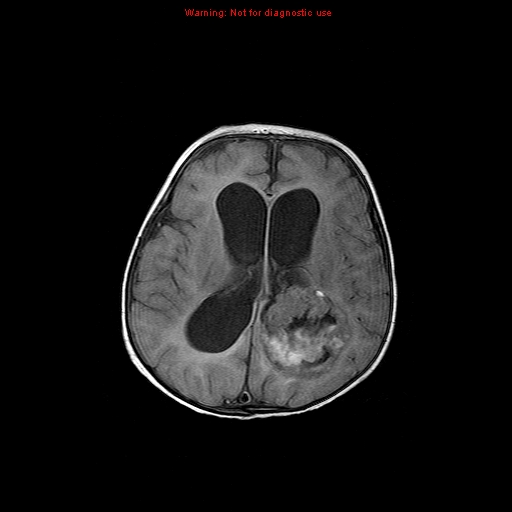 File:Atypical teratoid rhabdoid tumor (Radiopaedia 10712-11183 Axial FLAIR 7).jpg