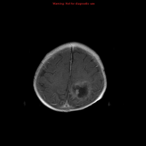 File:Atypical teratoid rhabdoid tumor (Radiopaedia 10712-11183 Axial T1 C+ 3).jpg