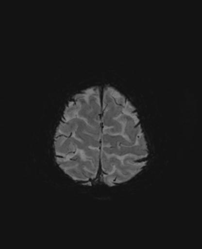 Autoimmune limbic encephalitis (Radiopaedia 30363-31005 SWI - mIP 65).jpg