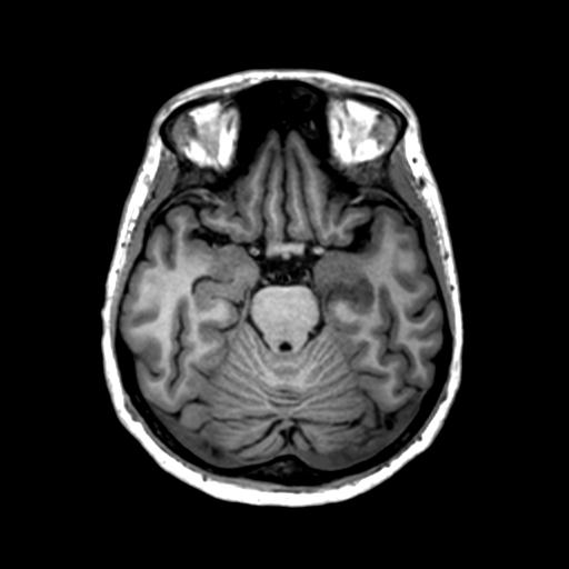Autoimmune limbic encephalitis (Radiopaedia 30363-31005 T1 Axial 1mm 57).jpg
