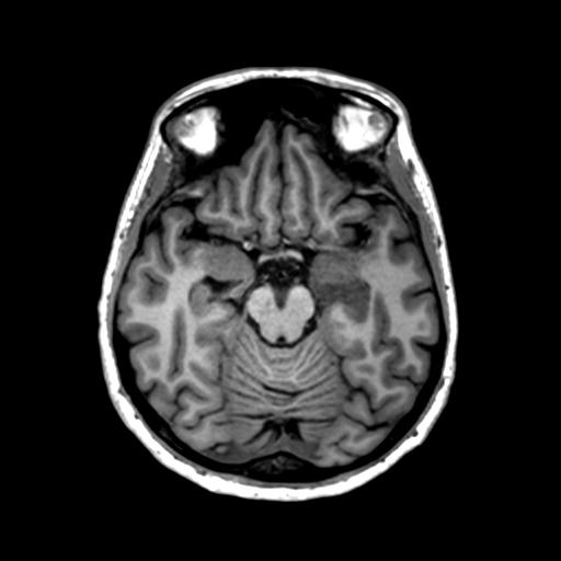 Autoimmune limbic encephalitis (Radiopaedia 30363-31005 T1 Axial 1mm 60).jpg