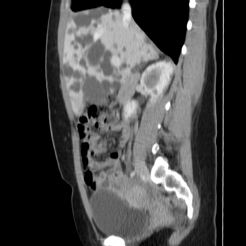 Autosomal dominant polycystic kidney disease (Radiopaedia 23061-23093 F 21).jpg