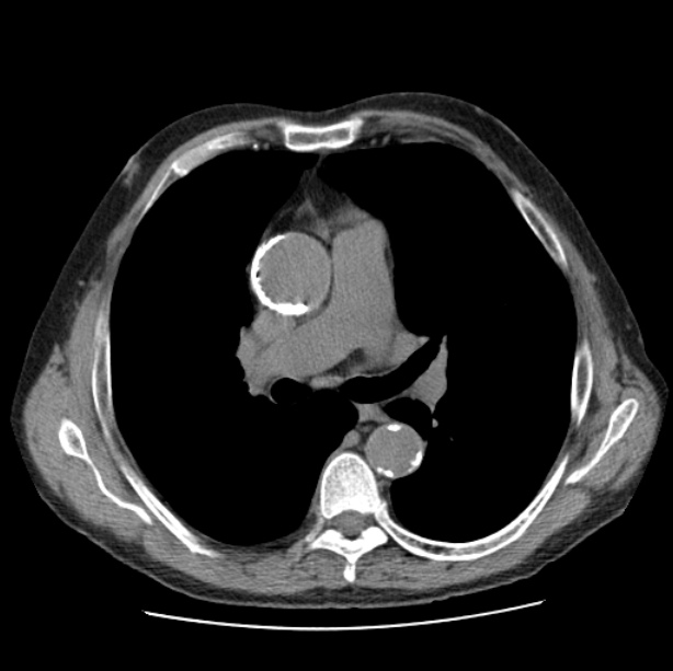 Autosomal dominant polycystic kidney disease (Radiopaedia 27851-28094 Axial non-contrast 25).jpg