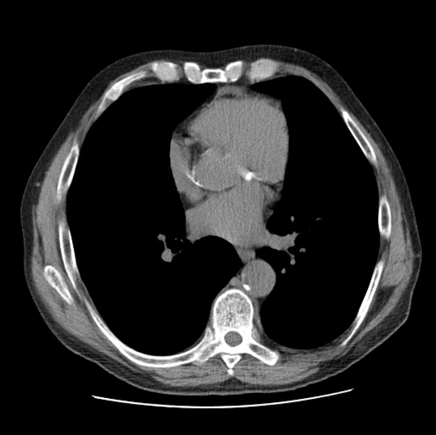 Autosomal dominant polycystic kidney disease (Radiopaedia 27851-28094 Axial non-contrast 33).jpg