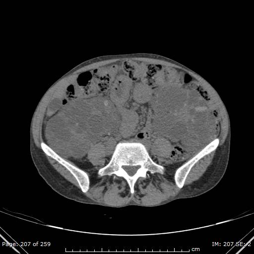 Autosomal dominant polycystic kidney disease (Radiopaedia 44122-47684 Axial non-contrast 74).jpg