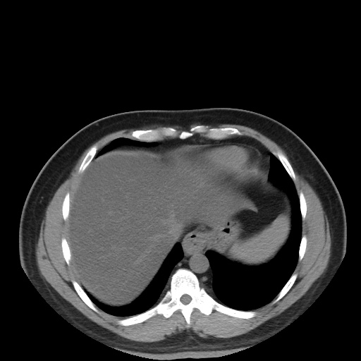 Autosomal dominant polycystic kidney disease (Radiopaedia 50259-55612 Axial non-contrast 15).jpg