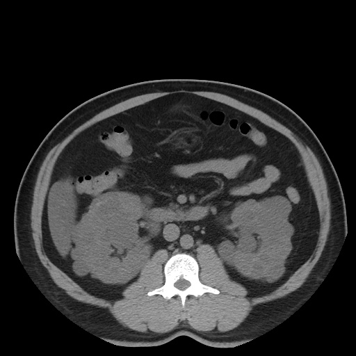 Autosomal dominant polycystic kidney disease (Radiopaedia 50259-55612 Axial non-contrast 39).jpg
