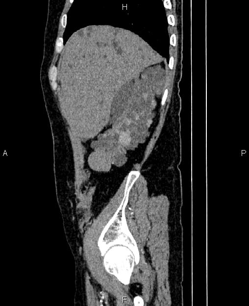 Autosomal dominant polycystic kidney disease (Radiopaedia 87830-104287 C 14).jpg