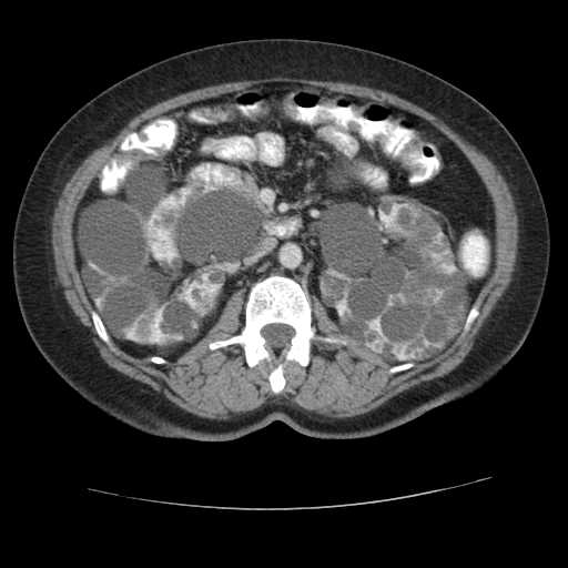 Autosomal dominant polycystic kidney disease with hepatic involvement (Radiopaedia 32693-33662 B 35).jpg