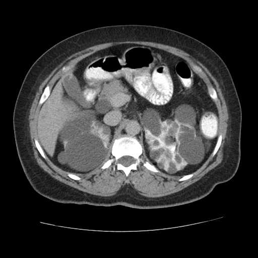 Autosomal dominant polycystic kidney disease with hepatic involvement (Radiopaedia 32693-33662 C 26).jpg