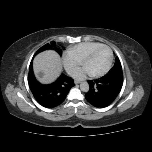 Autosomal dominant polycystic kidney disease with hepatic involvement (Radiopaedia 32693-33662 C 3).jpg