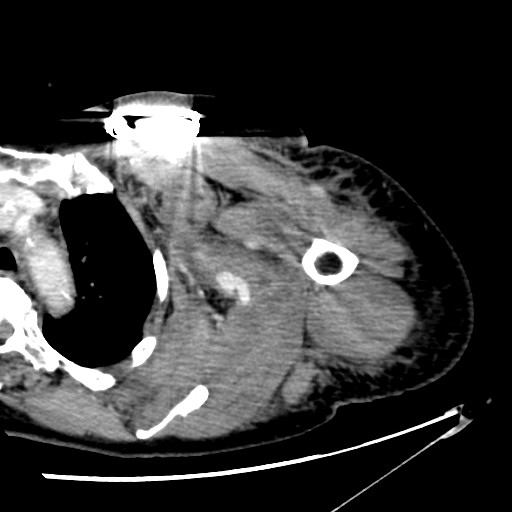 File:Axillary arterial pseudoaneurysm (Radiopaedia 24925-25195 A 13).jpg