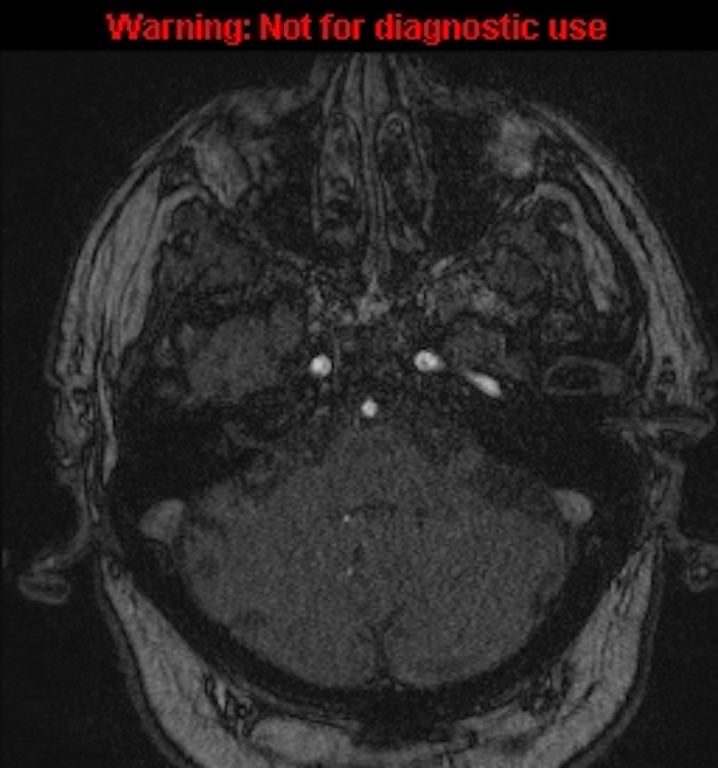 Azygos anterior cerebral artery (Radiopaedia 59325-66677 Axial MRA 31).jpg