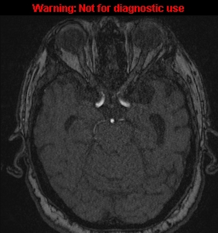 Azygos anterior cerebral artery (Radiopaedia 59325-66677 Axial MRA 58).jpg