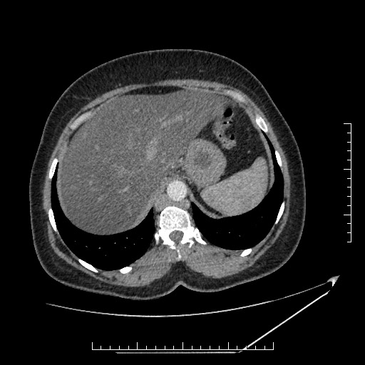 File:Azygos continuation of the IVC (Radiopaedia 40416-42965 A 15).jpg