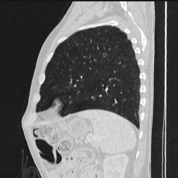 Azygos lobe (Radiopaedia 38259-40275 lung window 79).jpg
